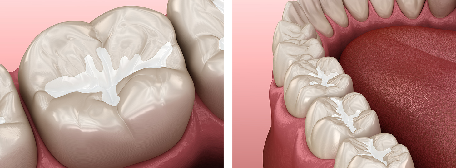 Sealants on teeth